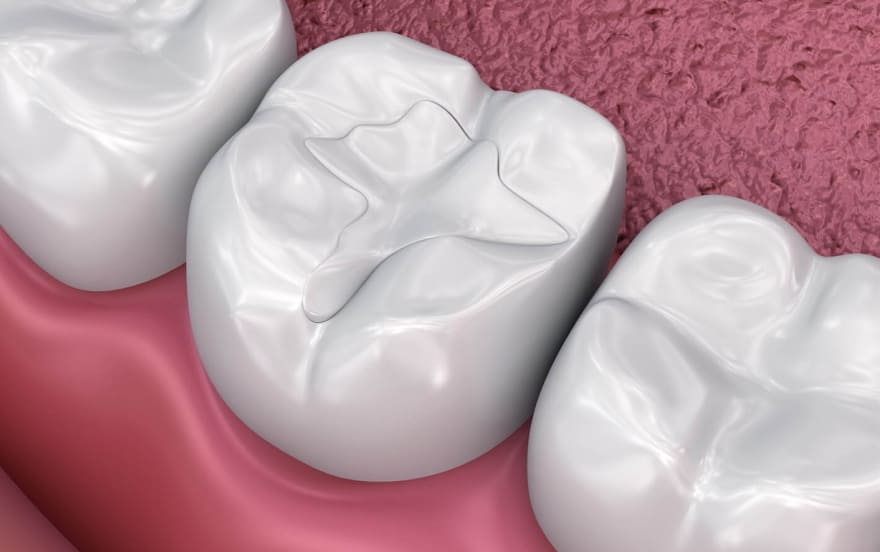 Склоіономерна пломба